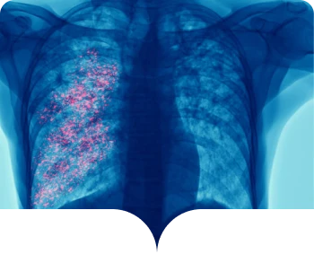 Imagen de pulmones