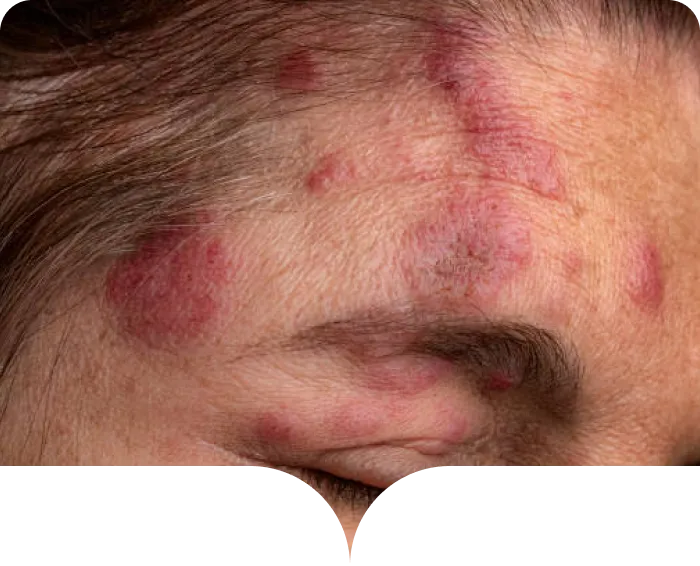 Persona con herpes zóster