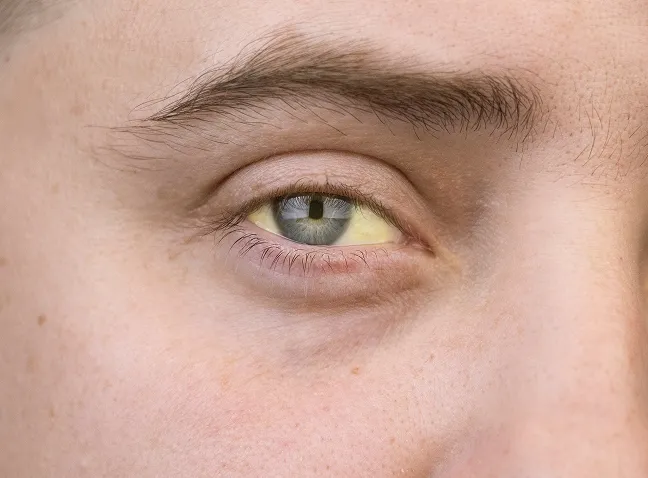 Ilustración de los síntomas de la Hepatitis A