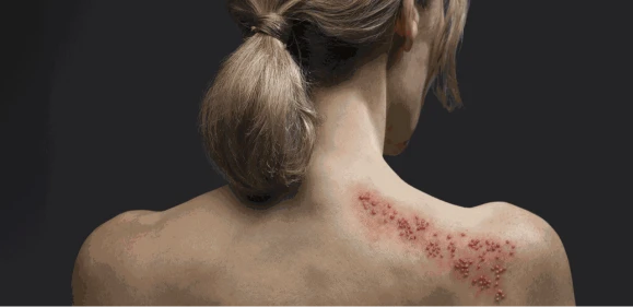 Herpes zóster