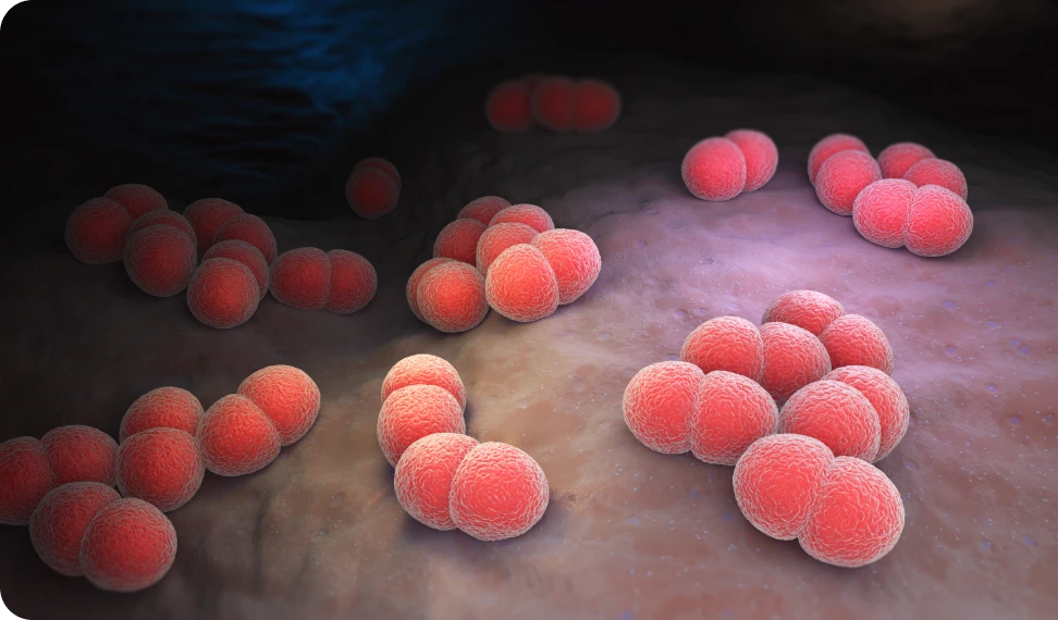 Ilustración de los síntomas de la meningitis