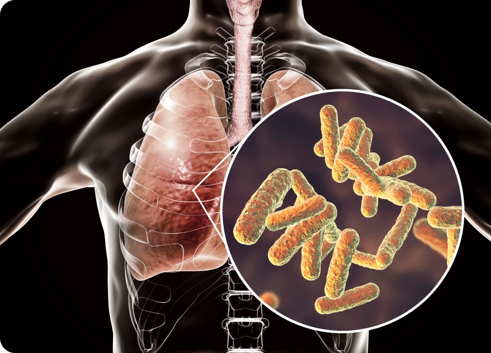 Sintomas de la tuberculosis