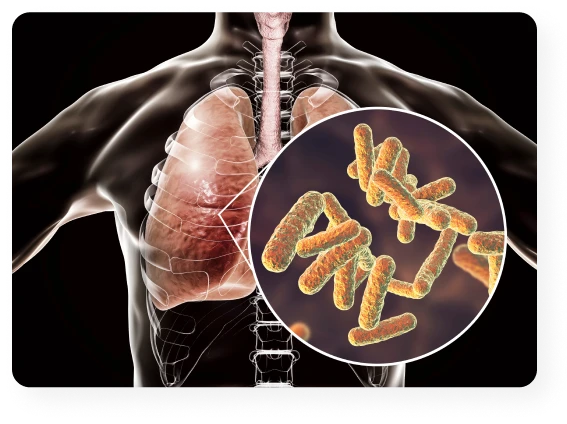 Sintomas de la tuberculosis