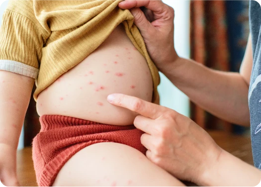 Sintomas de la varicela